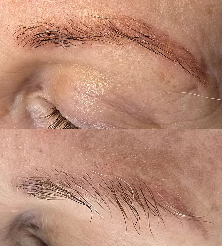 Eyebrow Tattoo Removal Before and After Williamstown Melbourne