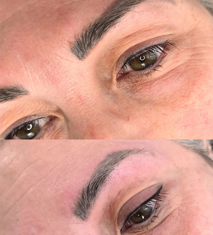 Eyebrow Tattoo Removal Before and After Williamstown Melbourne