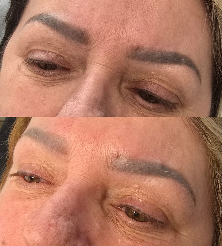 Eyebrow Tattoo Removal Before and After Williamstown Melbourne