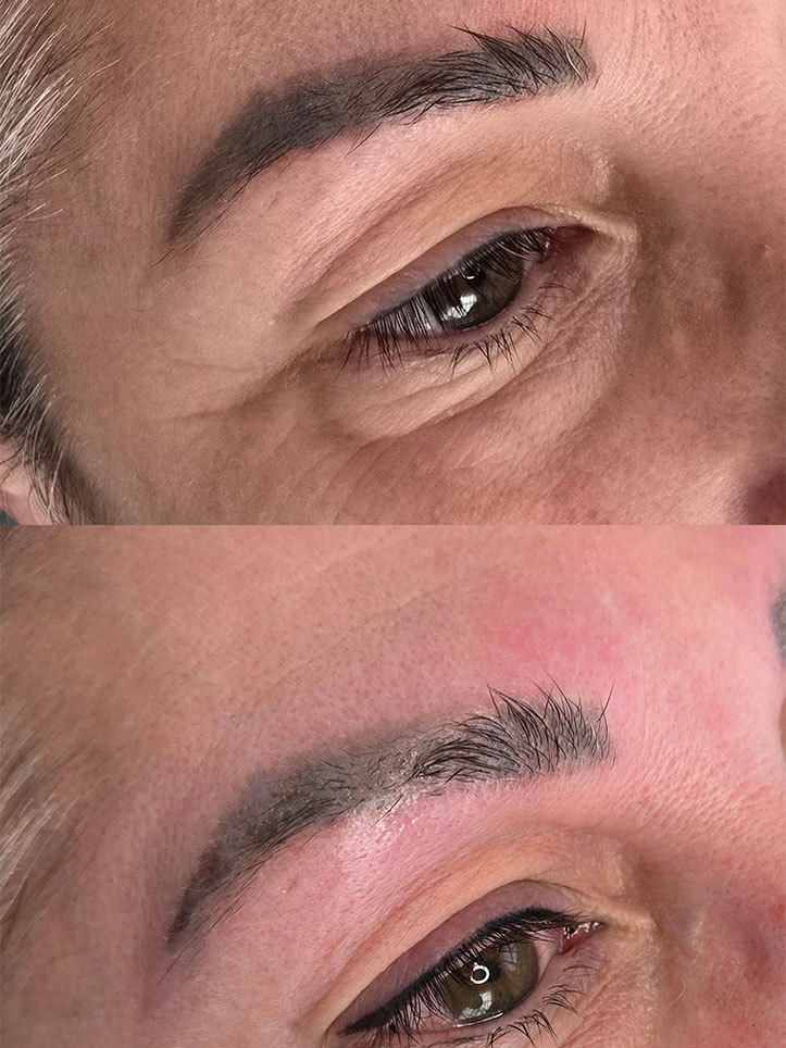 Eyebrow Tattoo Removal Before and After Williamstown Melbourne