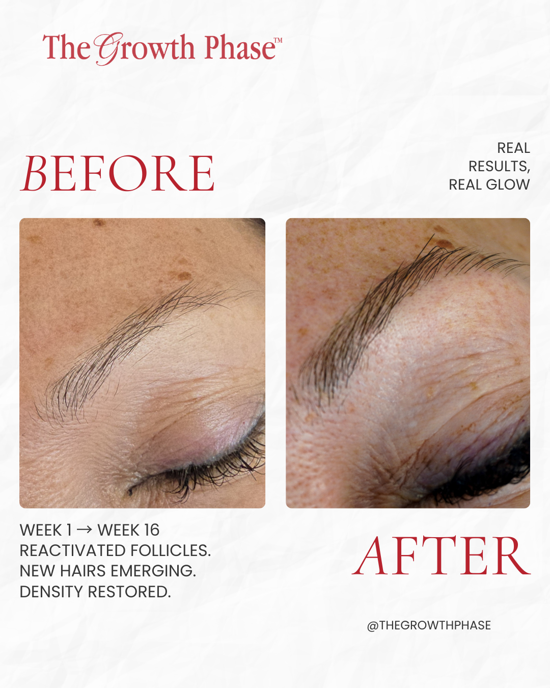 1_20260307_085348_0000 Brow Regeneration Before and After Results The Growth Phase Melbourne