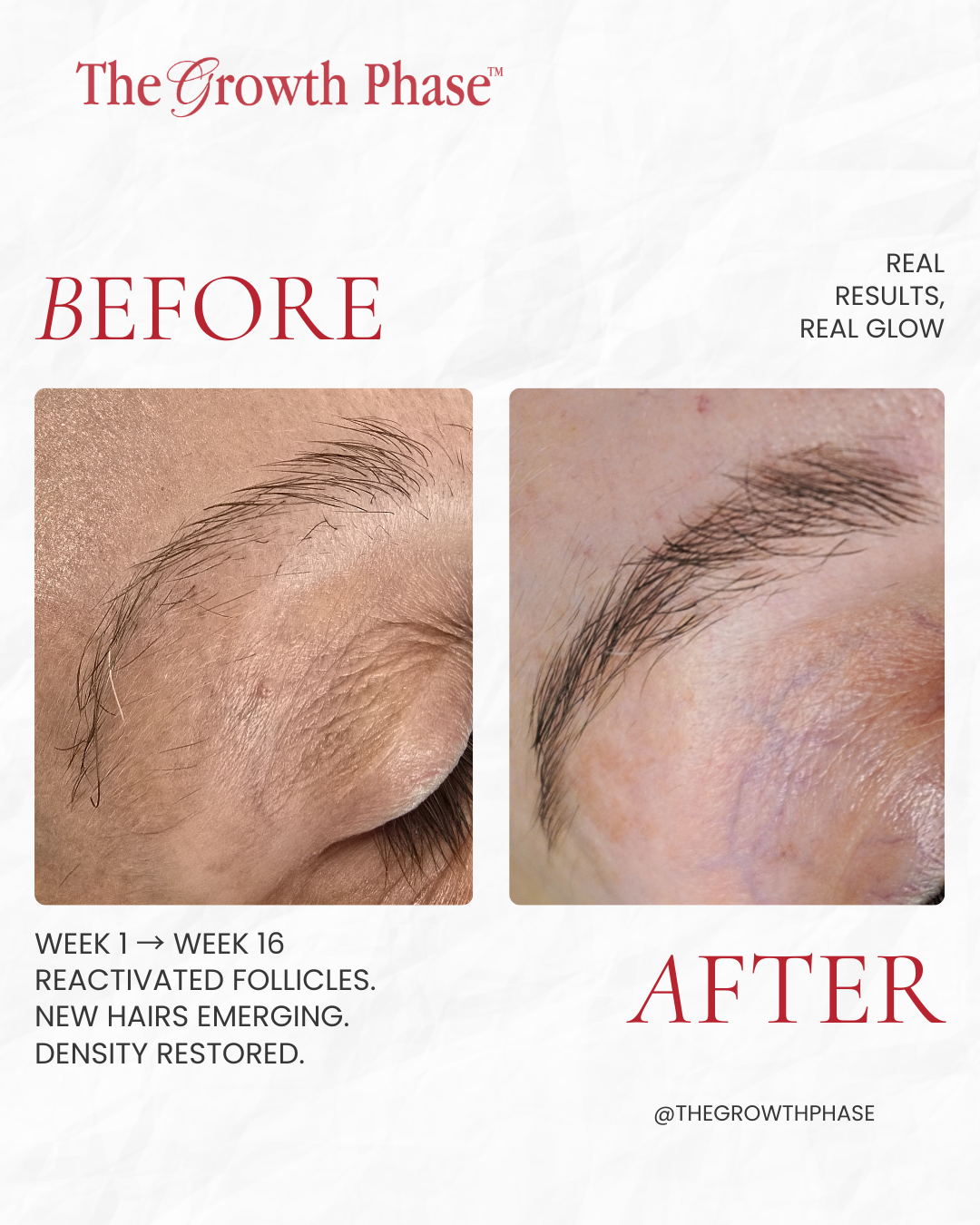 1_20260308_182456_0000 Brow Regeneration Before and After Results The Growth Phase Melbourne